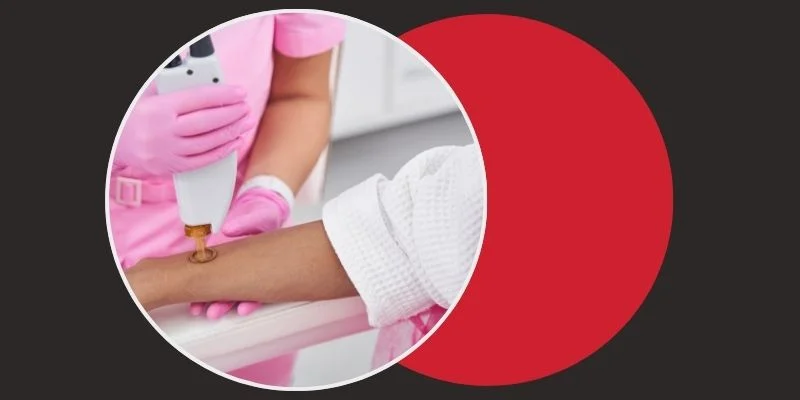 DIODE LASER HAIR REMOVAL IN CHENNAI