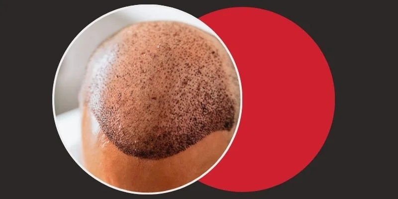 Hair Transplant in Chennai